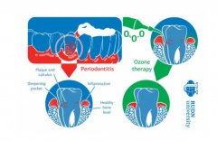 RUDN 大學(xué)牙醫(yī)建議采用基于臭氧的綜合抗炎療法